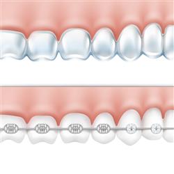 BRACES ^ ALIGNERS