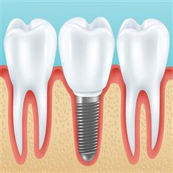 DENTAL IMPLANTS