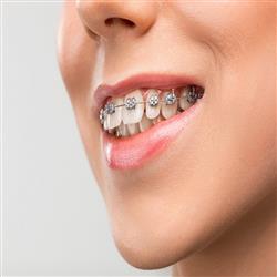 CLEAR ALIGNERS